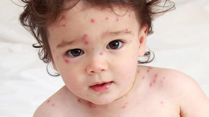 6 điều cần biết về bệnh thủy đậu ở trẻ