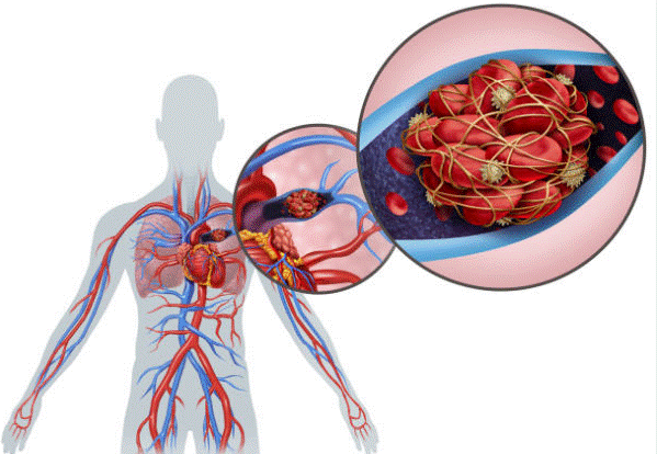 Thuyên tắc mạch phổi do suy giãn tĩnh mạch có thể gây tử vong
