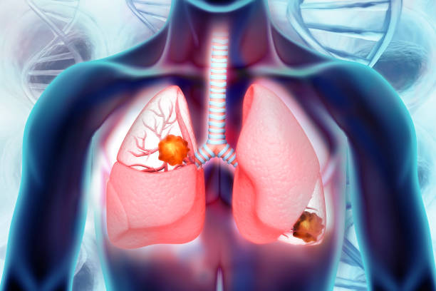 COPD có thể dẫn đến biến chứng ung thư phổi