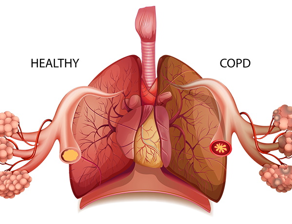 Tại sao người bệnh COPD có nguy cơ cao mắc Covid-19 với mức độ trầm trọng hơn?