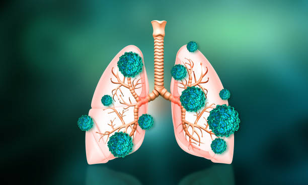 Phải làm sao để phòng ngừa lao phổi tái phát?