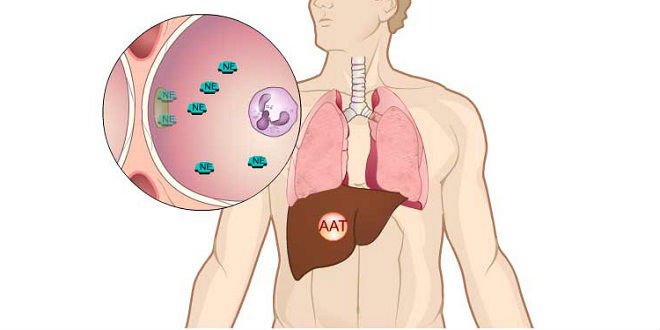 Thiếu Alpha-1 antitrypsin (AAT) khiến người trẻ tuổi dễ bị phổi tắc nghẽn mạn tính
