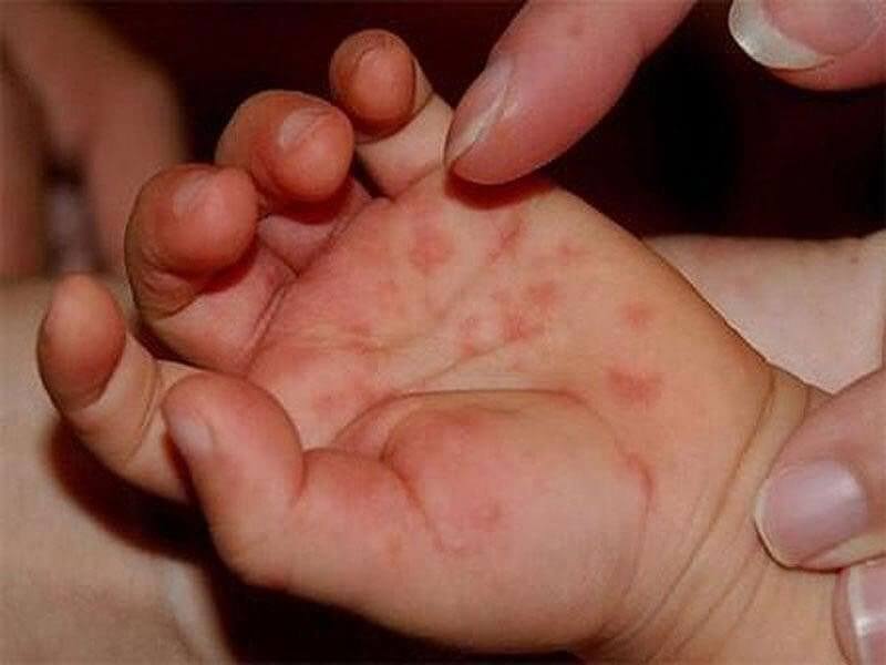 Tìm hiểu về bệnh tay chân miệng để cha mẹ phòng tránh cho con trẻ