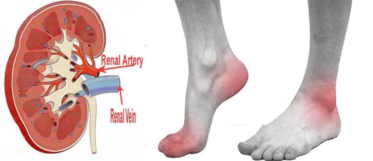 biến chứng trên thận của bệnh gut