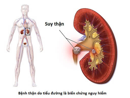 Biến chứng thận của bệnh tiểu đường, Đừng chủ quan mà hối hận !