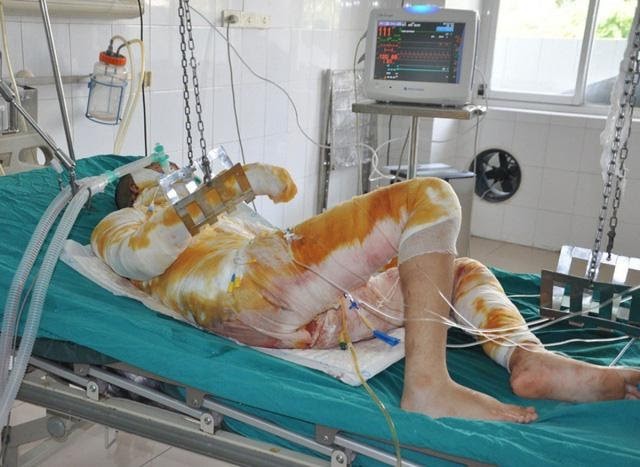 Nguy hiểm khôn lường khi dùng cồn nướng mực