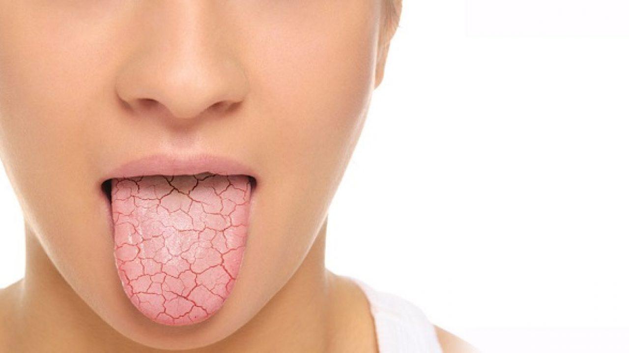 Miệng giảm tiết nước bọt khiến vi khuẩn dễ phát triển gây hôi miệng