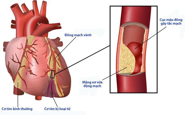 Đường huyết cao gây ra nhiều biến chứng trên tim mạch.
