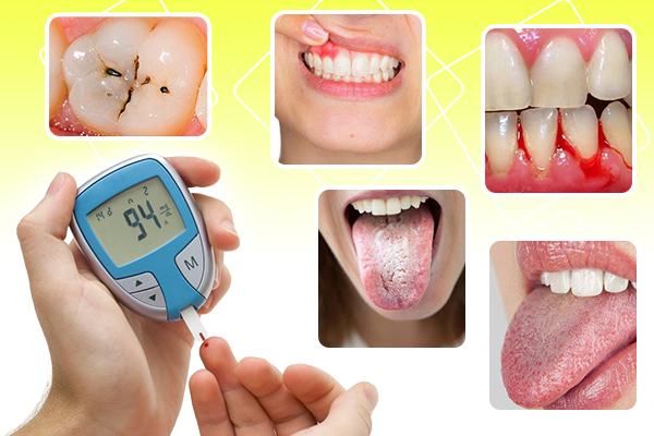 Người bệnh tiểu đường sẽ gặp phải những biến chứng răng miệng nào?