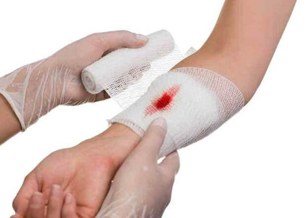 Xử lý vết thương đúng cách giúp phòng tránh biến chứng nhiễm trùng