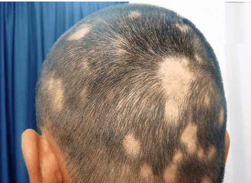  Lượng tóc rụng và mọc lại của mỗi người là khác nhau