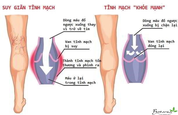 Suy giãn tĩnh mạch ở phụ nữ và một số biện pháp phòng ngừa