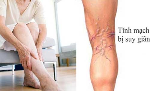 Lời khuyên hữu ích cho bệnh suy giãn tĩnh mạch