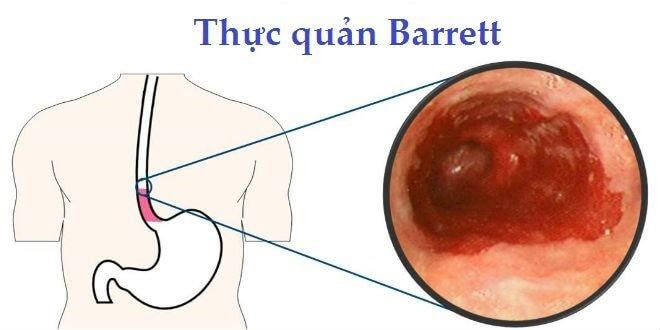 barrett thực quản