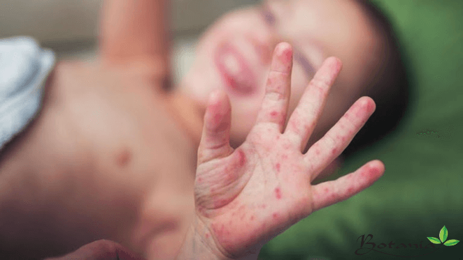 Tìm hiểu về bệnh tổ đỉa ở trẻ em