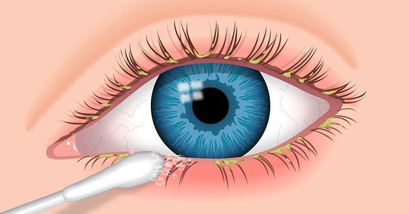 Làm sạch gỉ và dịch bám trên mí mắt
