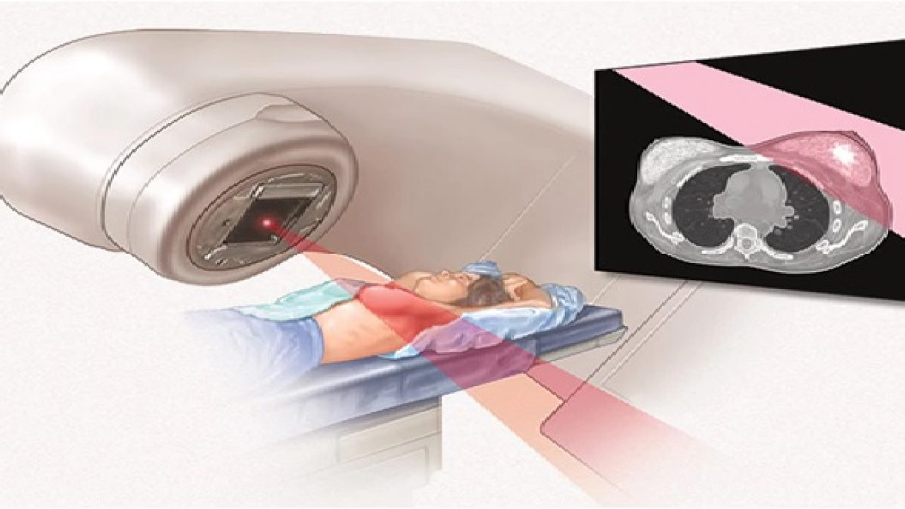 Điều trị ung thư vú bằng xạ trị