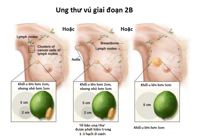 Hình ảnh ung thư vú giai đoạn 2B.