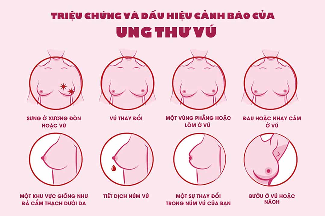 Những dấu hiệu và triệu chứng của ung thư vú giai đoạn đầu