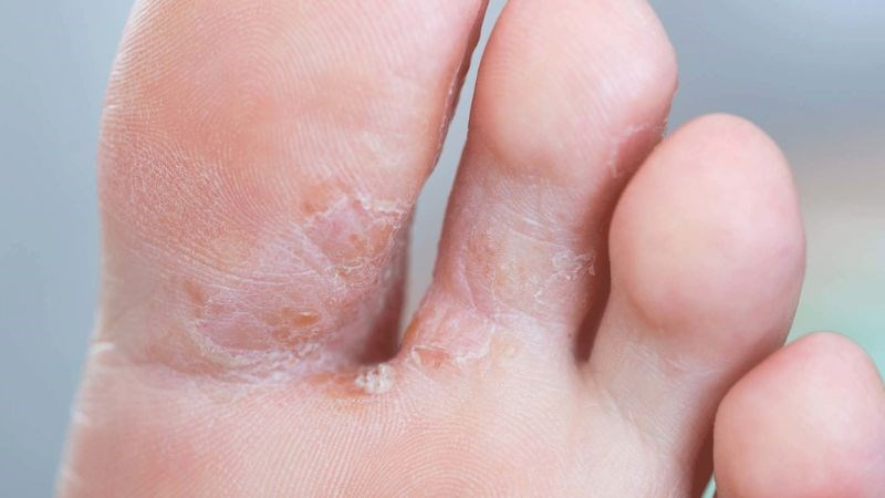 Nước ăn chân là bệnh lý thường gặp mùa mưa lũ.