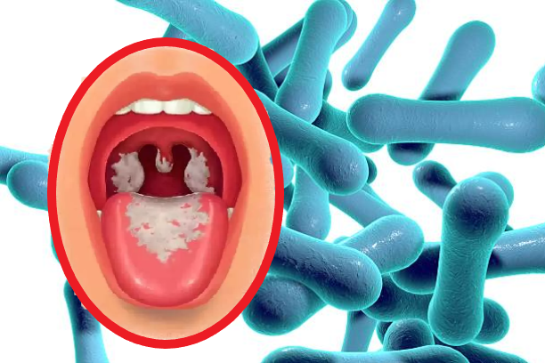 Những điều cần biết về bệnh bạch hầu
