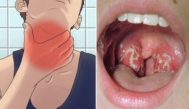 Bệnh nhân bị đau cổ, khó nuốt, xuất hiện giả mạc trắng trong cổ họng