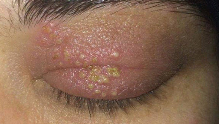 Nốt phồng rộp ở trên mí mắt của người bệnh zona thần kinh mắt