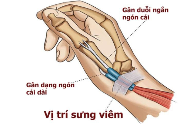 Đau cổ tay do viêm bao gân De Quervain.