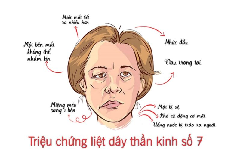 Các triệu chứng liệt dây thần kinh số 7