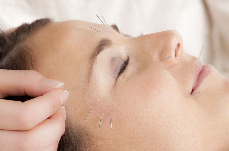 Châm cứu điều trị liệt dây thần kinh số 7