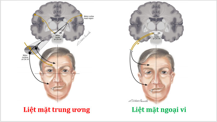  Phân biệt liệt dây thần kinh số 7 trung ương và ngoại biên