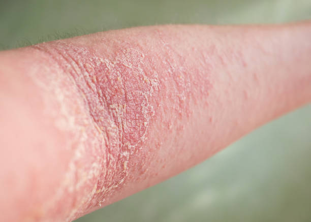 Nguyên nhân gây da khô nứt nẻ ở mùa rét là gì?
