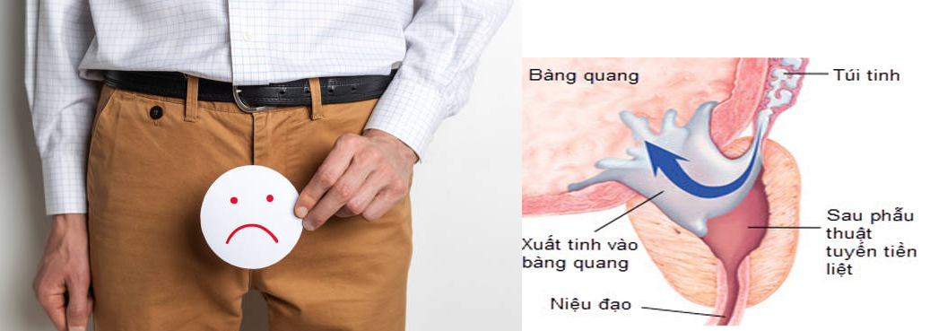 Xuất tinh ngược dòng gây vô sinh nam