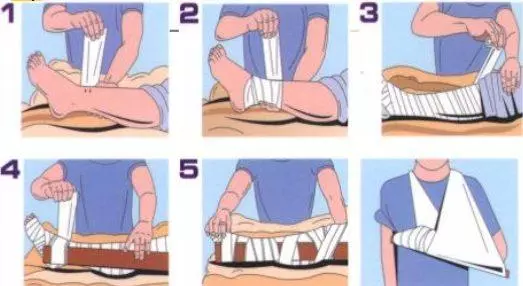 Băng nẹp ép bất động chi khi bị rắn cắn.