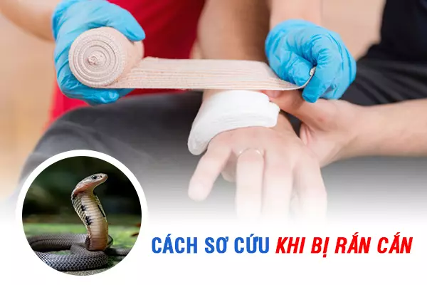 Hướng dẫn cách sơ cứu khi bị rắn cắn mới nhất 2023