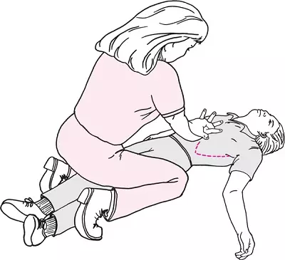 Thủ thuật Heimlich tư thế nằm