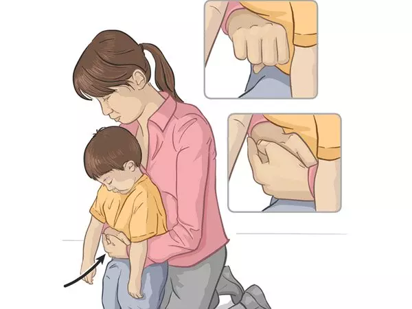 Thủ thuật Heimlich