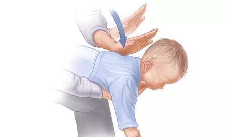 Thủ thuật vỗ lưng, ấn ngực