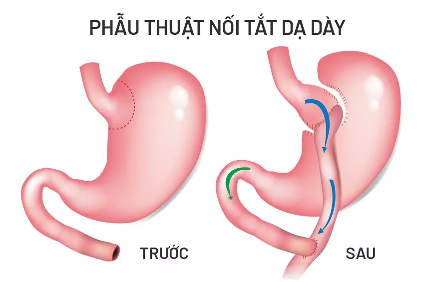 Phẫu thuật giảm cân: nối tắt dạ dày