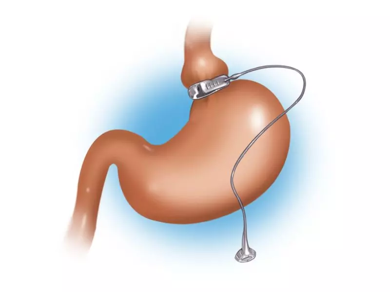 Tìm hiểu về các phương pháp phẫu thuật giảm cân