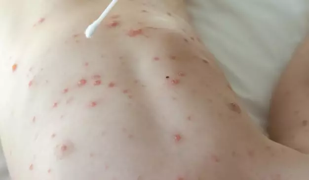 Bệnh thủy đậu lây qua đâu, điều trị sao cho hiệu quả?