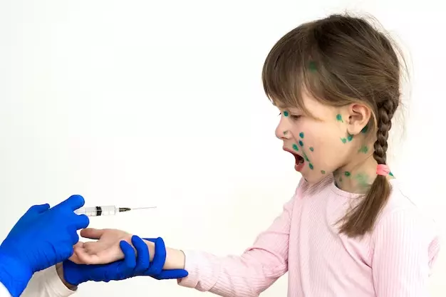 Điều trị bệnh thủy đậu