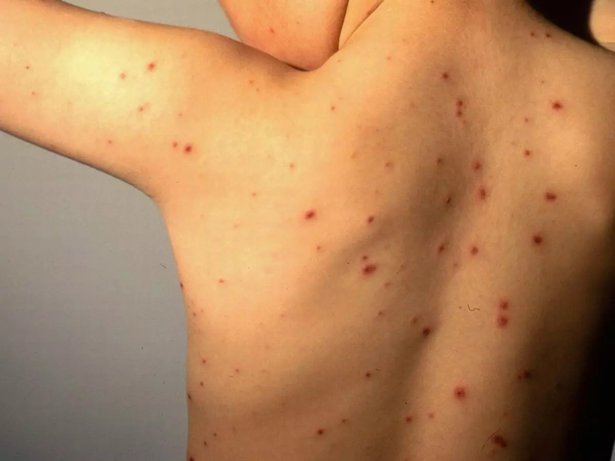 mụn nước bắt đầu khô và đóng vảy