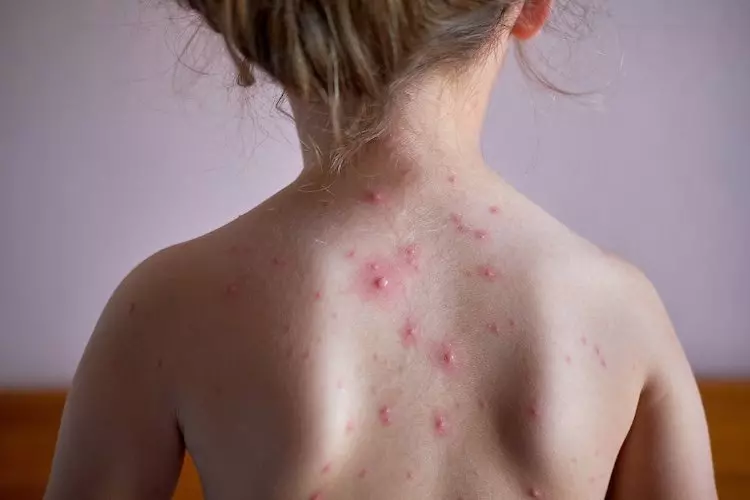 nốt ban đỏ nổi mụn nước