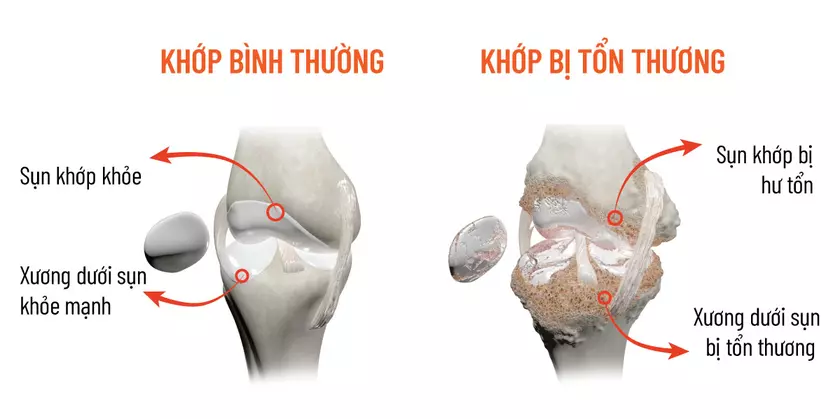 Tổn thương xương dưới sụn do thoái hóa khớp gối