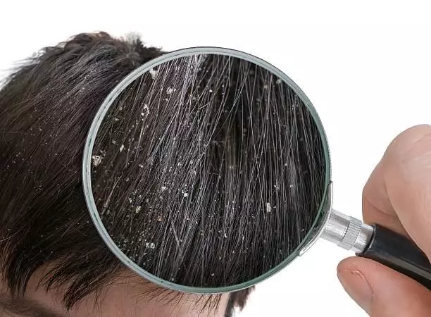5 sự thật bạn cần biết về gàu