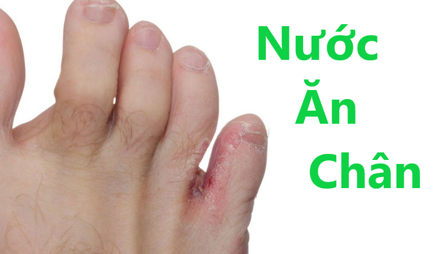 Nước ăn chân - Nguyên nhân, cách điều trị và phòng ngừa tái phát