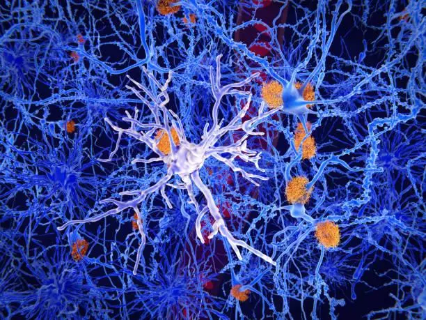 Não bệnh nhân mắc Alzheimer