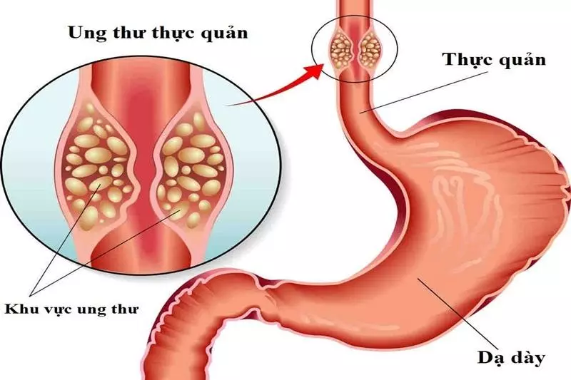 Ung thư thực quản thường được phát hiện muộn