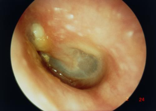 Bệnh Cholesteatoma ở bệnh nhân mắc viêm tai giữa mạn tính.